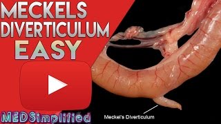 Meckels Diverticulum Made Easy [upl. by Hras18]