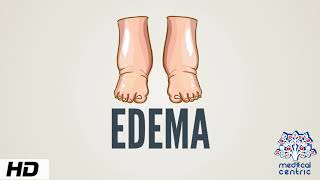 Edema Causes Signs and Symptoms Diagnosis and Treatment [upl. by Hamid]