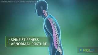 Ankylosing Spondylitis Symptoms [upl. by Emmerie]