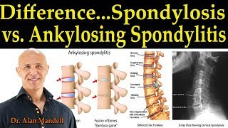 The Difference Between Spondylosis amp Ankylosing Spondylitis  Dr Alan Mandell DC [upl. by Anoid]