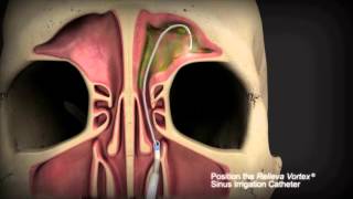 Diagnosing Sinus Infections [upl. by Calli]