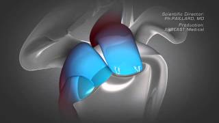 Shoulder Arthroscopy  Rotator Cuff Repair [upl. by Yrret]