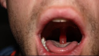 swollen throat clinical case answer and discussion [upl. by Lubbock99]