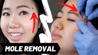 Facial mole removal demo  large mole removed from upper lip  fast and pain free [upl. by Batholomew]