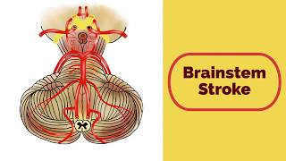 Brainstem Stroke Syndromes [upl. by Anisamot]