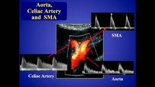 Mesenteric Ischemia [upl. by Mateya654]