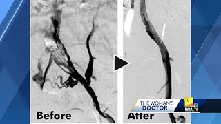 Doctor explains MayThurner Syndrome [upl. by Ode]