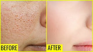 How to Get Rid of Large OPEN PORES Permanently  Anaysa [upl. by Aicined760]