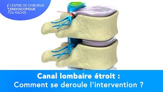 CANAL LOMBAIRE ÉTROIT  Comment se déroule lintervention [upl. by Jaeger]