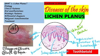 Oral Lichen planus Part 1 Causes Pathogenesis Clinical features Skin lesions [upl. by Aima218]