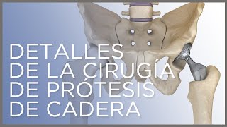 Detalles de la cirugía de prótesis de cadera Dr Ángel Villamor [upl. by Sammie]