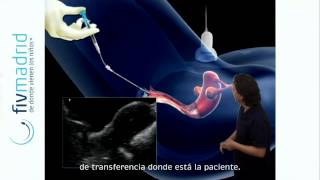 Transferencia embrionaria en FIV [upl. by Merrilee]