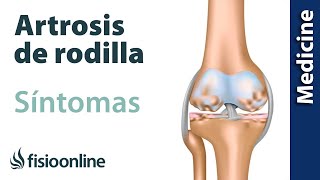 ¿Cómo entender y minimizar los síntomas de la Artrosis de rodilla [upl. by Rice]