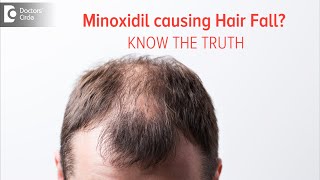 KNOW THE TRUTH  Does Minoxidil Solution cause Hair Fall Dr Deepak P Devakar  Doctors Circle [upl. by Luehrmann]