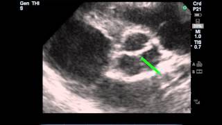 Parasternal Short Axis View Aortic Level Zoom  annotated [upl. by Attelrak]