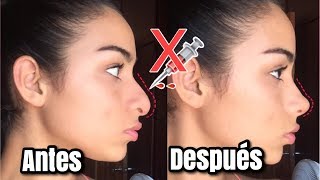 RINOPLASTIA CASERA EN MINUTOS  RESPINGADORES PARA NARIZ BONITA [upl. by Nwahsirhc356]