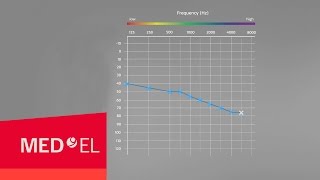 Audiograms Explained  MEDEL [upl. by Joris]