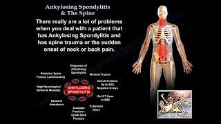 Ankylosing Spondylitis amp The Spine  Everything You Need To Know  Dr Nabil Ebraheim [upl. by Torres388]