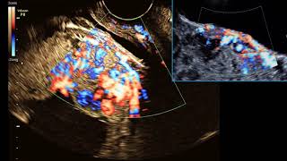 Training Module How to diagnose Placenta Accreta on Ultrasound [upl. by Akli]